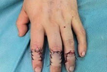 土媒：诺阿-朗的伤口很深，手指有部分断裂，需要缝合