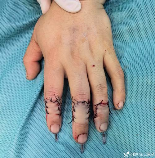 土媒:诺阿-朗的伤口很深,手指有部分断裂,需要缝合